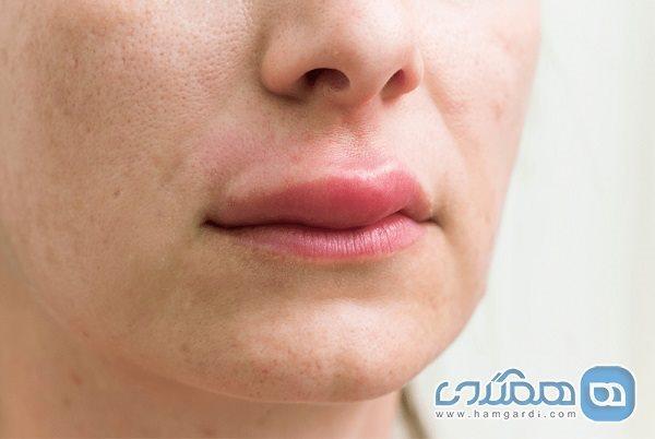 درباره آنژیوادم چه می دانیم؟